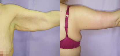 Брахиопластика фото до и после. Подтяжка рук
