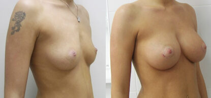 Увеличение груди фото до и после. Маммопластика