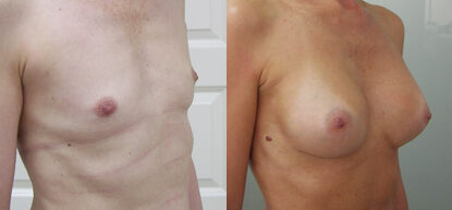 Увеличение груди фото до и после. Маммопластика