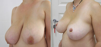 Уменьшение груди фото до и после. Редукционная пластика груди