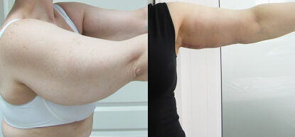 Брахиопластика фото до и после. Подтяжка рук