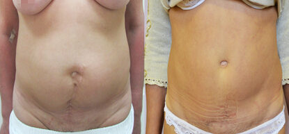 Абдоминопластика до и после фото